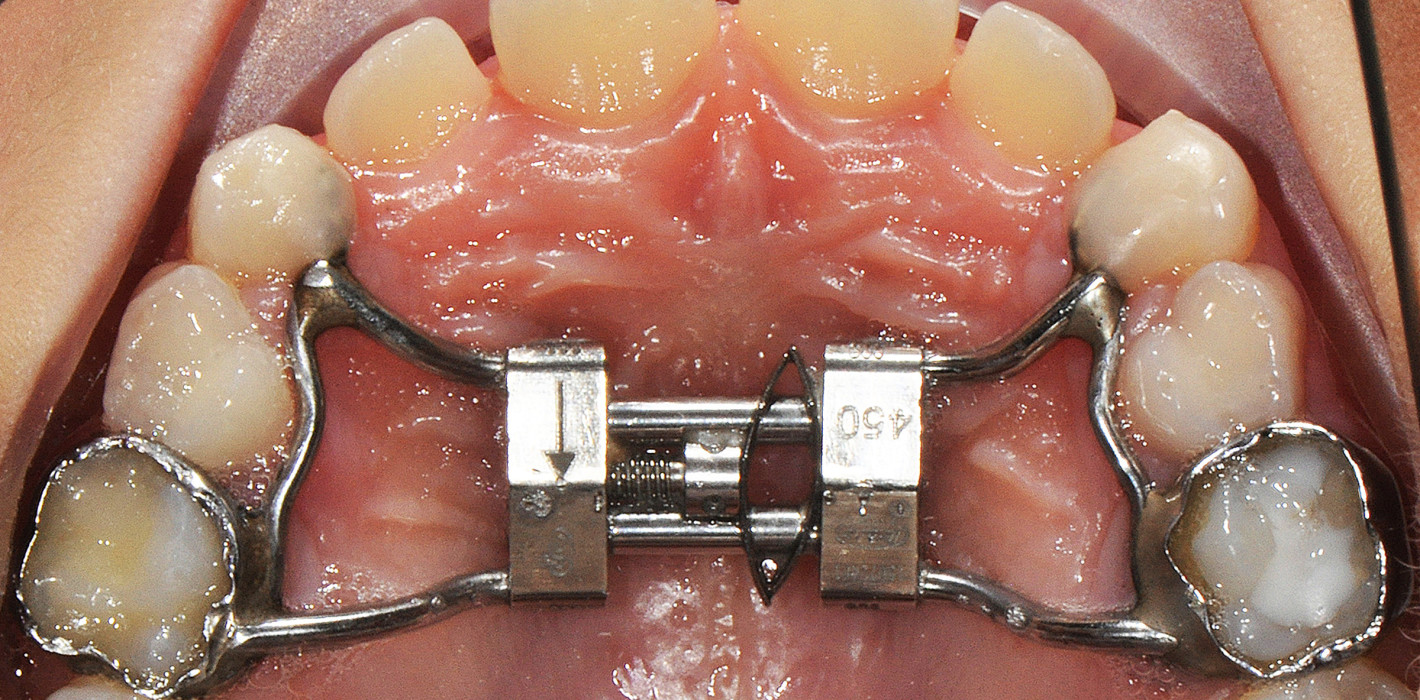 Langsame maxilläre Expansion mithilfe des Leaf Expanders ZWP online
